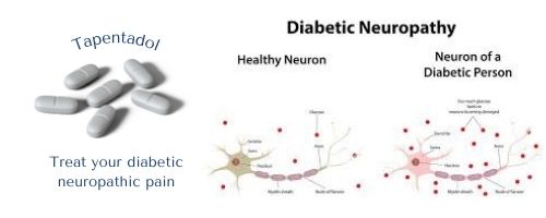 Tapentadol diabetic neuropathic pain solution