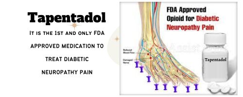 Tapentadol-to-treat-diabetic-neuropathic-pain