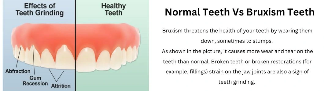 normal-teeth-and-the-teeth-of-patients